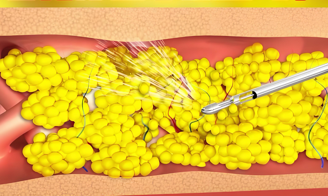 重庆黄彪抽脂实例www.236z.com