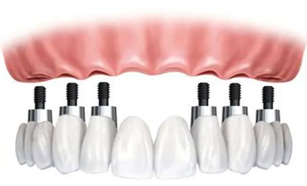 西安海濤口腔全口種植牙價(jià)格