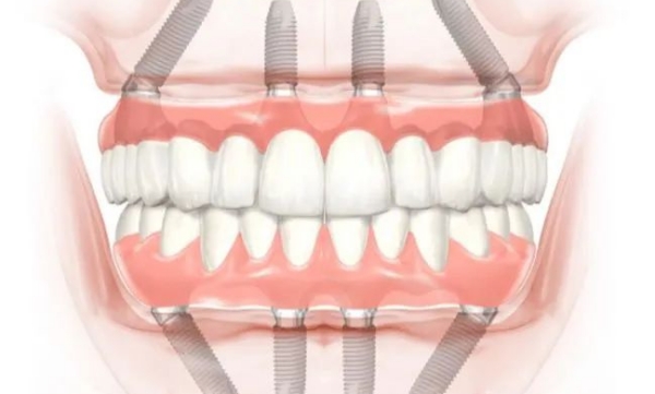 西安海濤口腔種植allon4價(jià)格