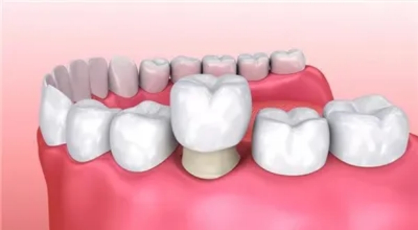 安康種植牙齒報(bào)銷政策與便利性