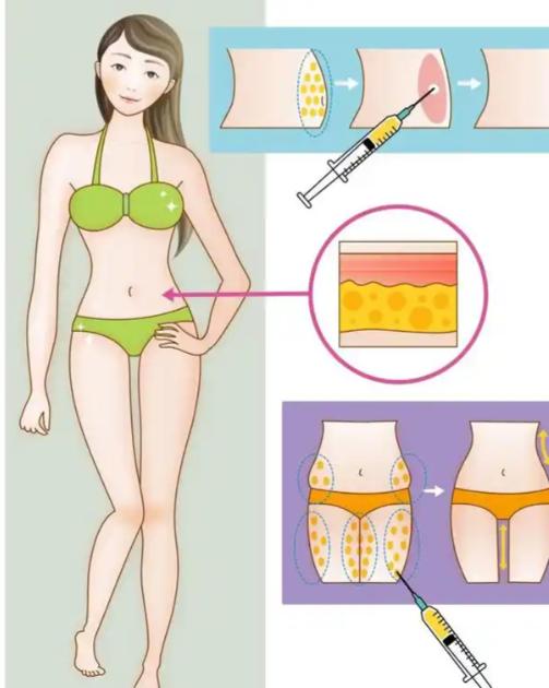 钟伟洪医生抽脂收费真实吗