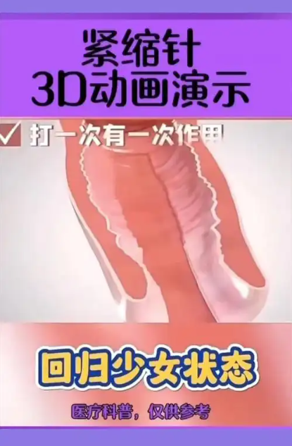 重慶縮緊針打之前需要檢查嗎