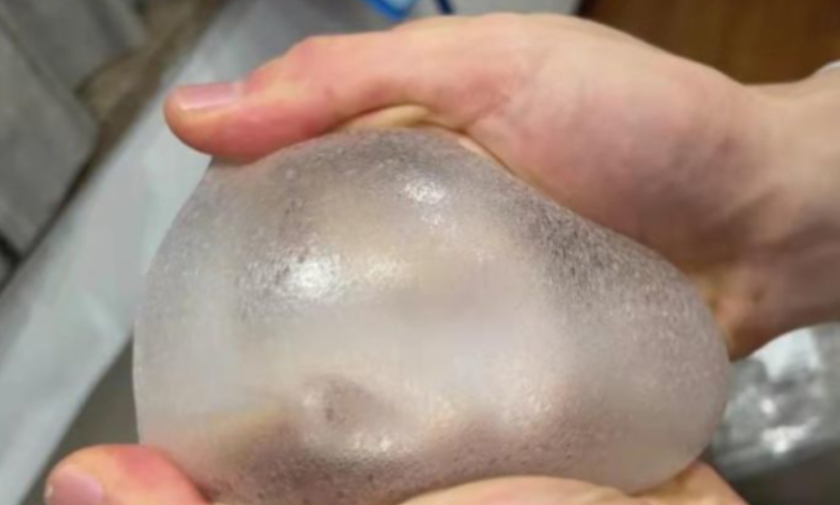 傲诺拉星熠术后真实感受