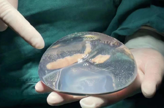 傲诺拉星熠术后变好过程与手感变化是怎样的?