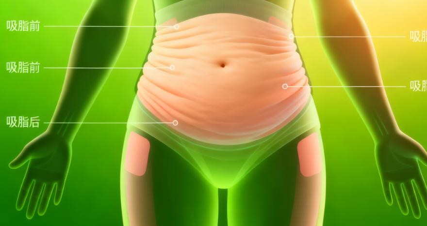 深圳10位患者说：黄海侠吸脂贵是因为“过程稳”，术后不用修