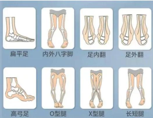 卢九宁多维直腿术包括哪些