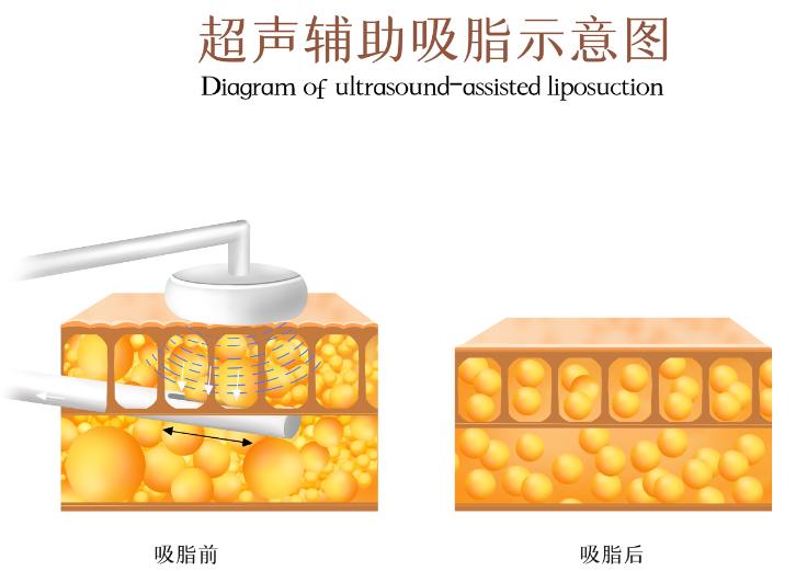 吸脂前后对比