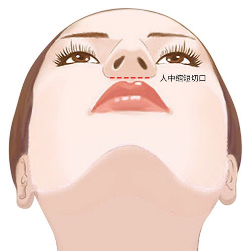 沈薇医生做人中缩短的3大核心优势