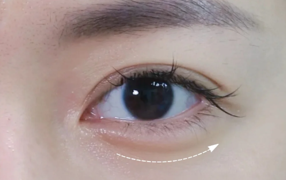 一、南宁做卧蚕填充好的医院名单（10 家高口碑机构，自然度拉满）​