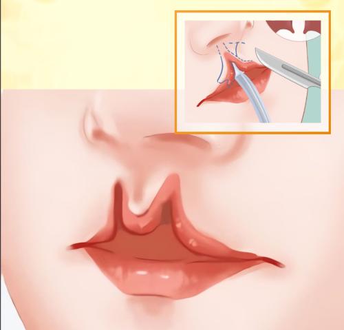 鼻唇裂伴鼻畸形修复