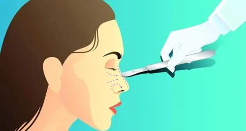 張輝赫本鼻技術(shù)保護(hù)