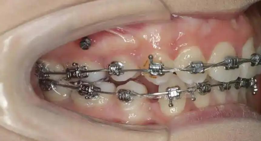 北京中諾口腔牙齒矯正為什么沒(méi)讓我后悔？