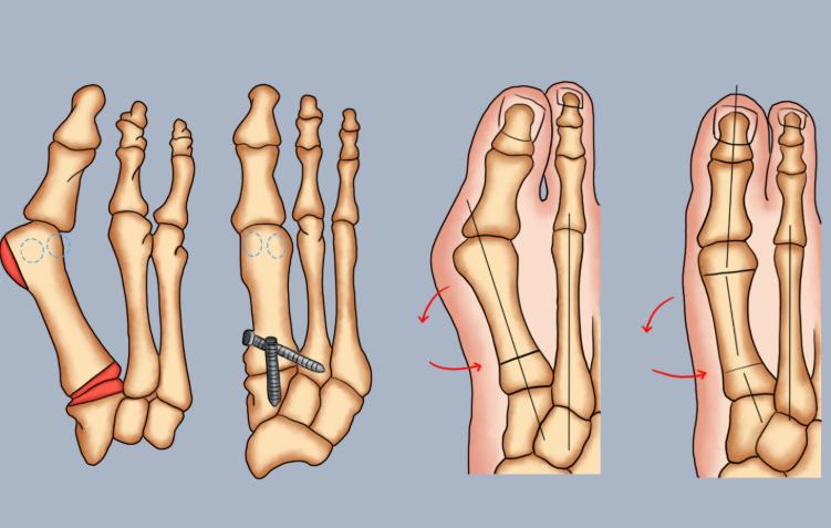 治疗拇外翻的技术