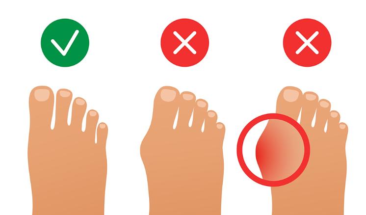 圣嘉新苏敬达治疗拇外翻的费用