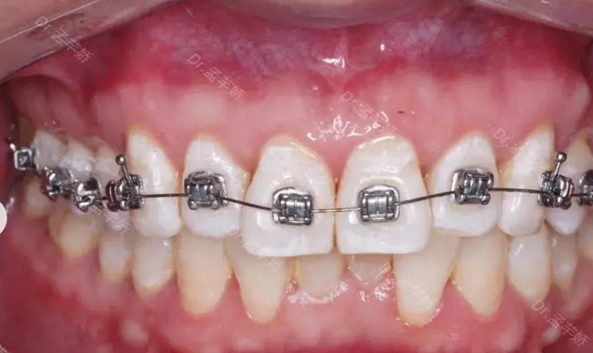 核心結(jié)論先擺好：2 年矯正不踩雷，3 大亮點超出預(yù)期