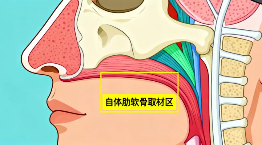 做鼻子的真实实例