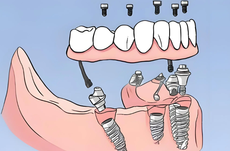 三、安康鑲牙醫(yī)院價格與選擇建議