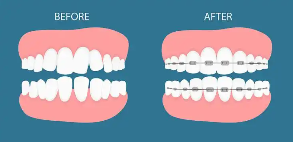 深圳正畸正頜聯(lián)合治療常見(jiàn)問(wèn)題解答