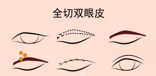 保定倾颜医疗美容双眼皮全流程精细化