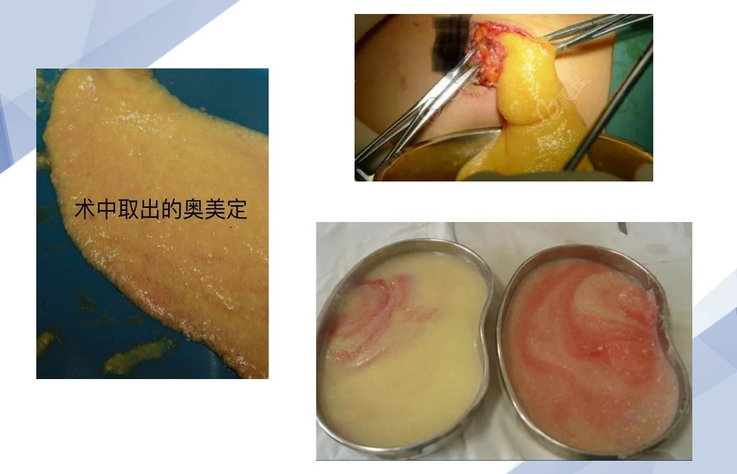 取出奥美定的样子