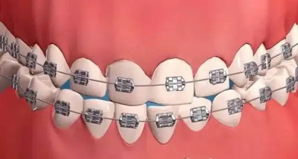 秀山金属托槽矫正价格