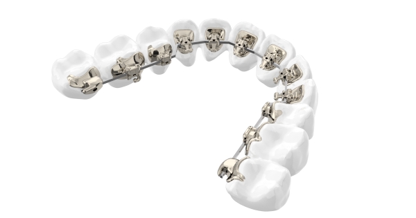 秀山牙科医院正畸选择