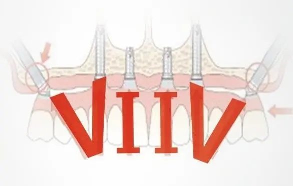 瑞士iti悅鋯種植體