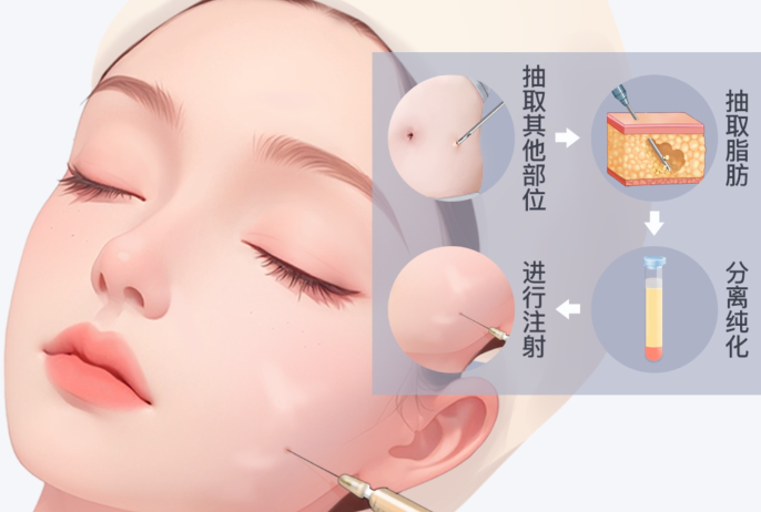 蔣錚錚微整形多少錢