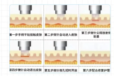 杭州华韩整形黄金微针价格：合理区间，多样选择