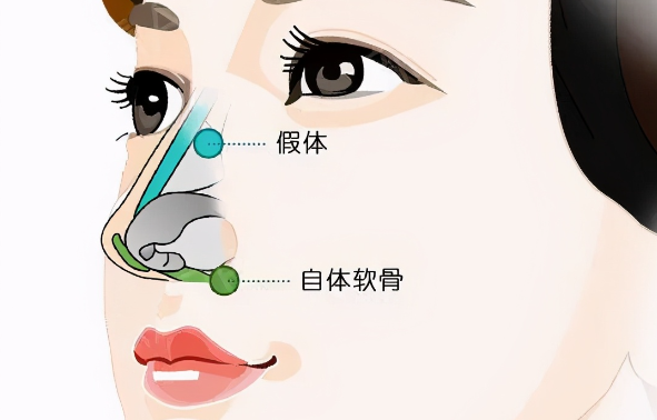 選擇包國(guó)宏醫(yī)生做鼻整形的注意事項(xiàng)