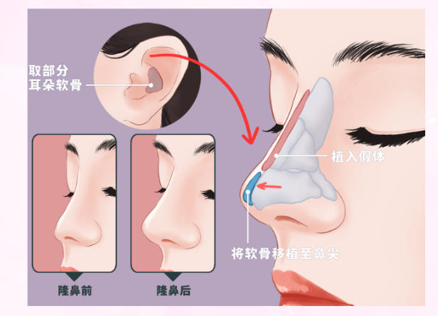 包國(guó)宏做鼻子的常見(jiàn)疑問(wèn)解答：價(jià)格、變好與適配性