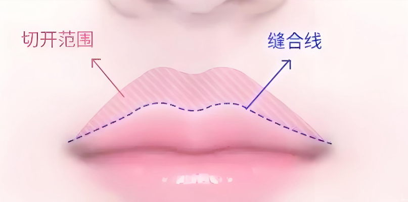 范开防医生三件套手术的技术优势
