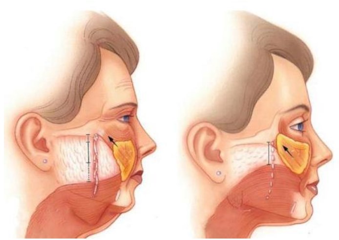 上海馥兰朵袁菊青春焕颜术价格表