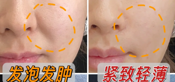 朱慧东博士谈馒化修复术后变好周期：3天能消肿吗？