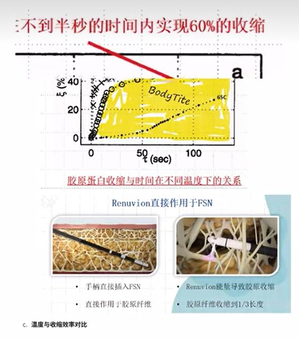 超能电浆吸脂原理