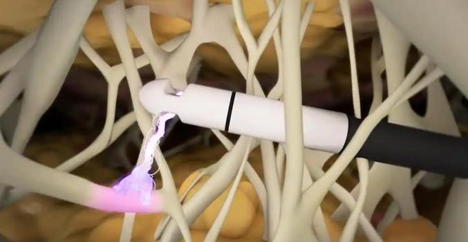 超能电浆与钻石微雕的价格构成及差异