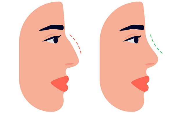 郑州张海洋和周蔚做鼻子的技术特点差异