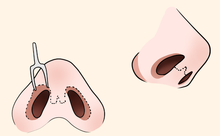 郑州张海洋和周蔚做鼻子的适合人群分析