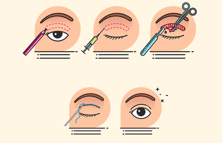谭章梅双眼皮修复算是大拿医生吗