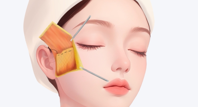 孙玮㻐速拉美面部提升价位