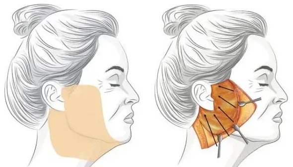 孙玮骏速拉美面部提升维持时间