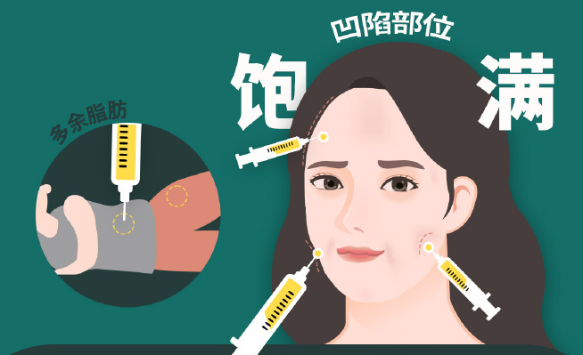 西安卢丙仑做脂肪填充怎么样www.236z.com