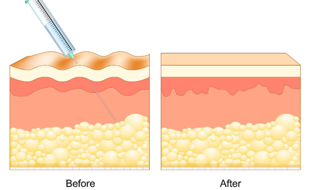 选择卢丙仑做脂肪填充的优势分析