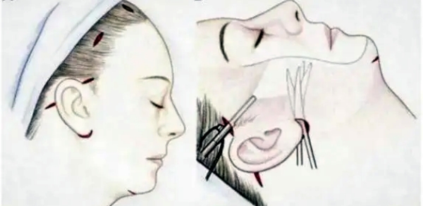 祝东升拉皮手术价格