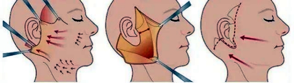 祝东升拉皮手术切口