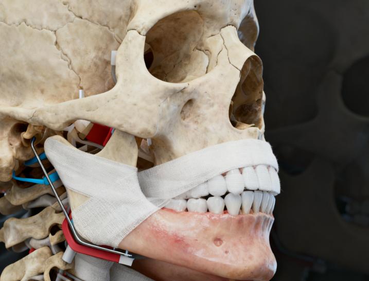 L型長曲線截骨 + 穩(wěn)準留角：為何成為張立天招牌