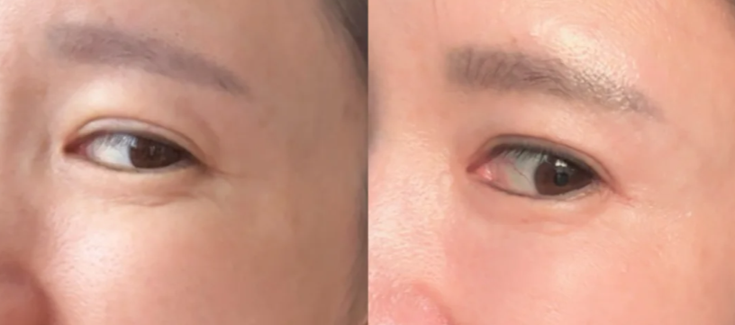 re2o膠原水光打眼部的注意事項(xiàng):確保成效與可靠