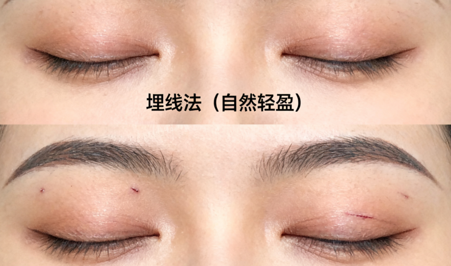 一、南京金东勋双眼皮实例到底怎么样？真实情况分享