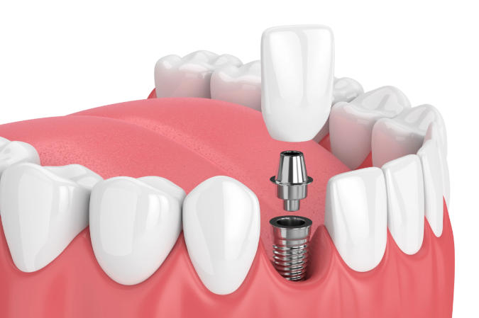 上海勛德口腔門診部種植