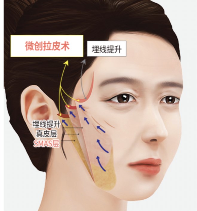 真实患者反馈：成都八大处拉皮手术谁做的好？患者实测说话